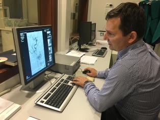 Trombektomia: przełomowa metoda leczenie udarów